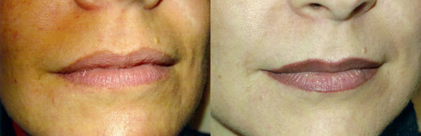 Before And After Images Of Lip Blush