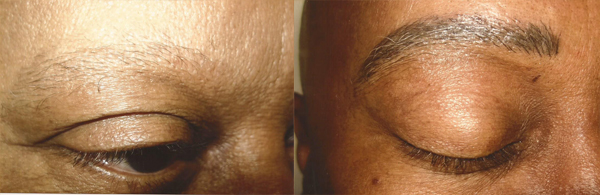 Before And After Images Of Mens Permanent Eye Brows