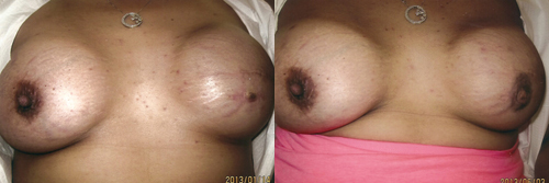 Before And After Images Of Areola Tattoo