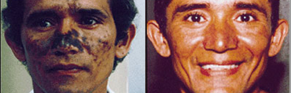 Before And After Images Of Microdermabrasion