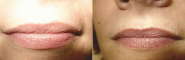 Before And After Images Of Lip Blush