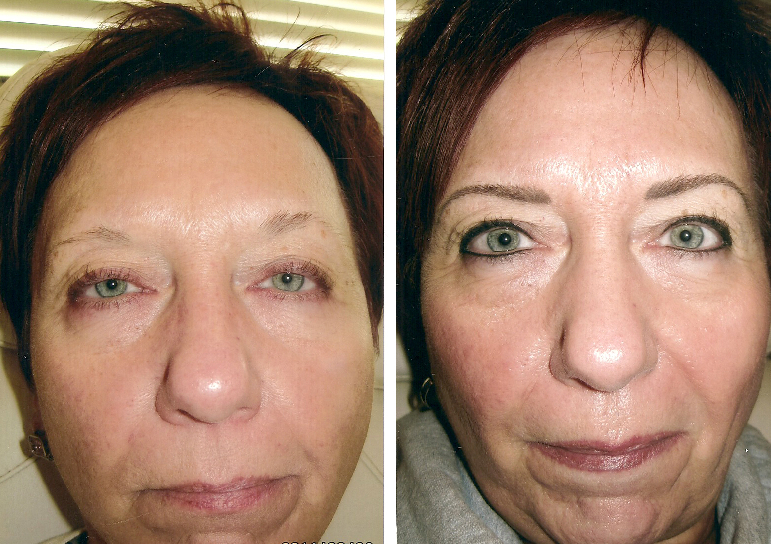 Before And After Images Of Full Face Permanent Makeup