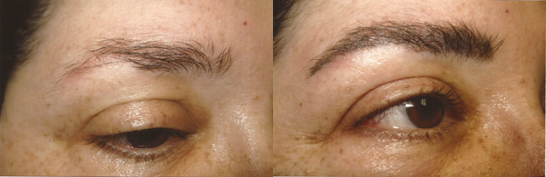 Before And After Images Of Mens Permanent Eye Brows