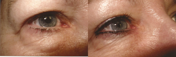 Before And After Images Of Permanent Eyeliner